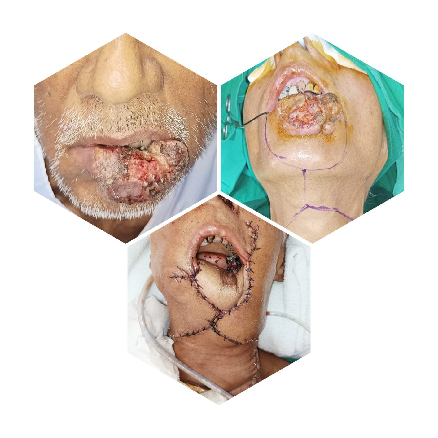 lip cancer management